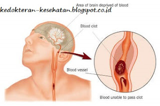 penyakit stroke dan pengobatannya