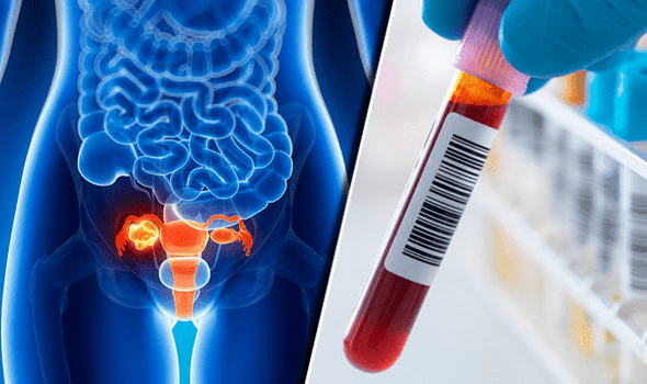 ovarian-cancer-blood-test