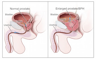 BPH Benign Prostatic Hyperplasia