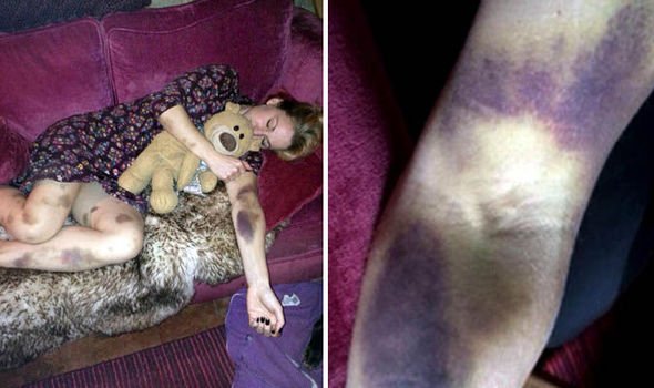 A 37-year-old Woman Woke Up One Morning With Horrible Bruises. What His Doctor Finds Is Terrible