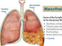 Mesothelioma Cancer: Symptoms of Mesothelioma Cancer