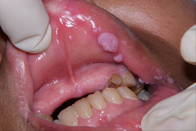 HPV-oral