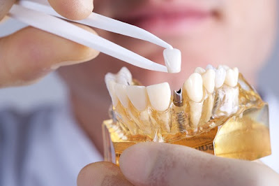 Người 30 tuổi cấy ghép răng implant có đau không? 2