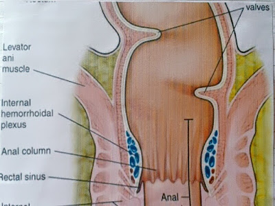 Gambar Wasir (Hemoroid) - Gejala, Tanda Dan Penyebab Hemoroid Atau Wasir