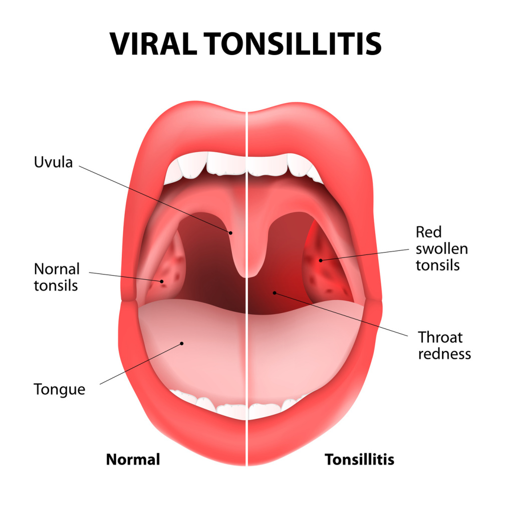 Blog Safeni Feni Produk Kecutkan Bengkak Tonsil Anak