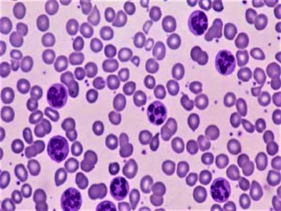 Megaloblastic Anemia