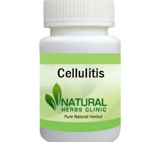 Herbal Product for Cellulitis