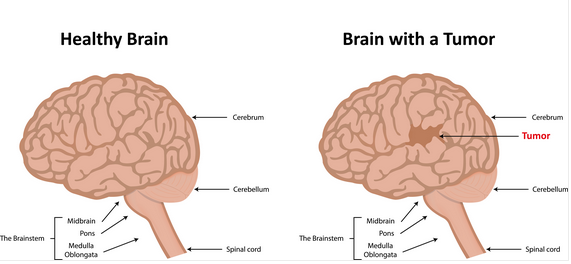  Brain tumor