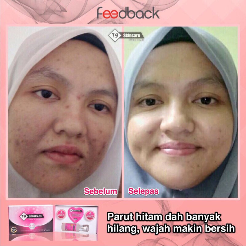 T9 SKINCARE: TIPS HILANGKAN JERAWAT BATU & RESDUNG