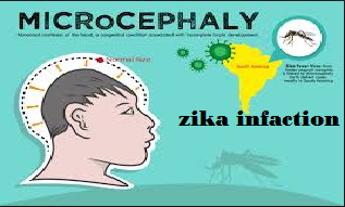 zika infection