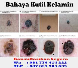 Obat Kutil Kelamin