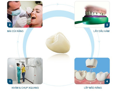 Các loại răng sứ thẩm mỹ hiện nay