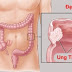 3 điều cần biết về ung thư đại trực tràng
