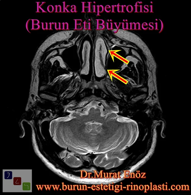 Burun etlerini büyümek zorunda bırakmayın! - Burun eti ameliyatı sonrasında, burun etleri neden yeniden  büyüyebilir? - Burun eti küçültülmesi için en ideal yöntem hangisidir? -  Lazerle burun eti ameliyatı mümkün müdür? - Burun etlerinin büyümemesi için önlemler