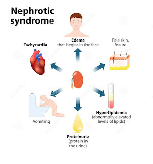 Tips Mencegah Nephrotic Syndrome / Penapis Buah Pinggang 
