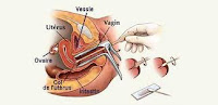 Pemeriksaan Test Pap Smear