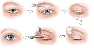 Cắt mí mắt ở đâu đẹp tphcm