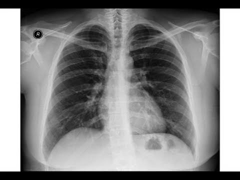 http://pathologyvideos.blogspot.ro/2014/04/chest-x-ray-idiopathic-pulmonary.html