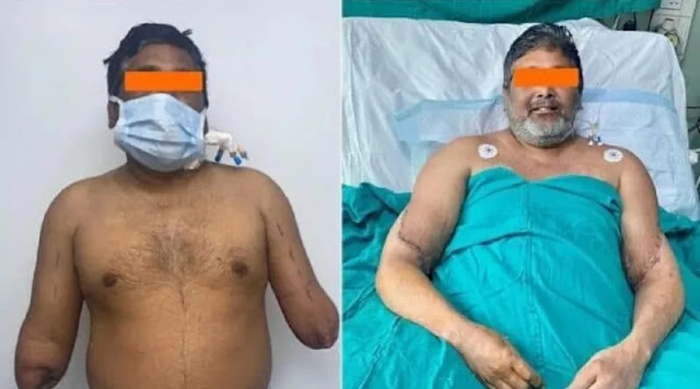 Un pintor de 45 años que perdió ambos brazos podría volver a crear tras un doble trasplante