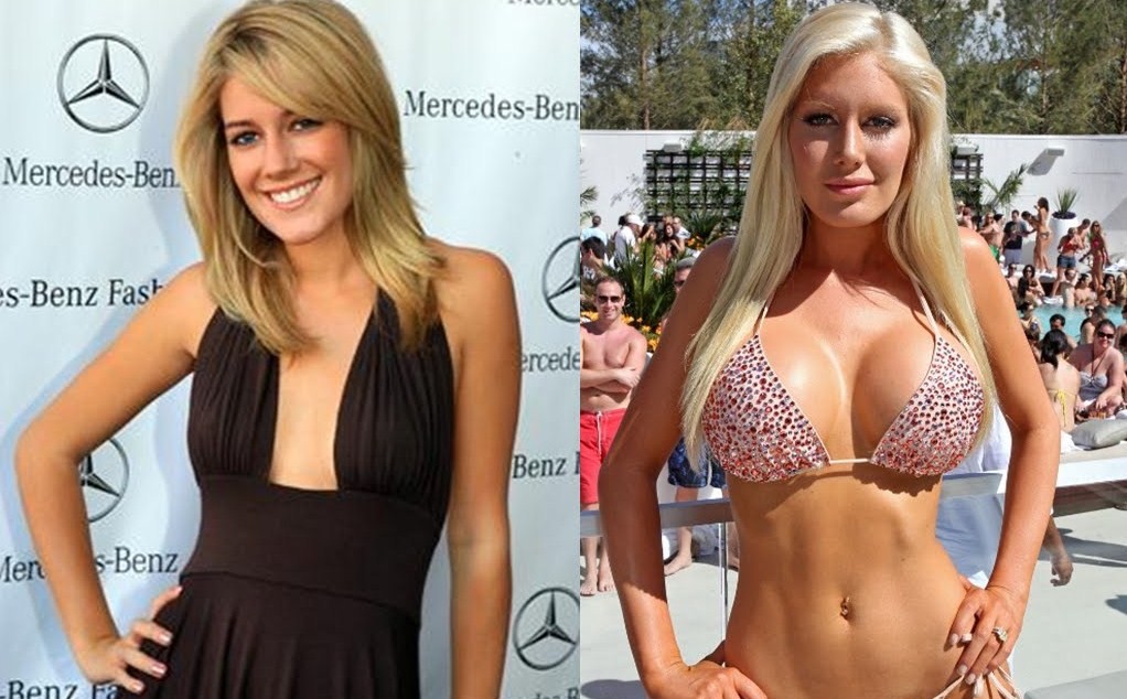 heidi montag plastic surgery before and after people. heidi montag before and after