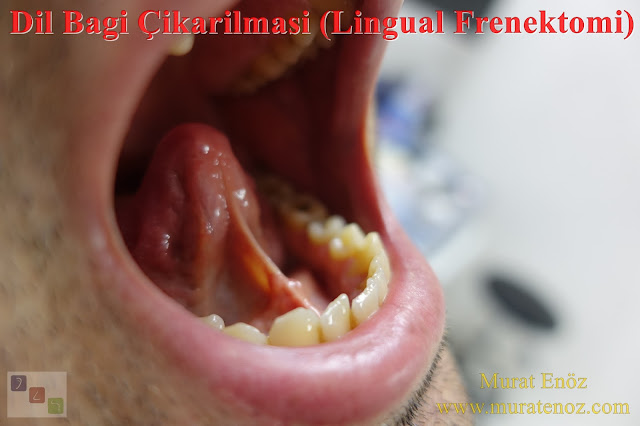 Dil bağı çıkarılması - Lingual frenektomi - Dil bağı tedavisi - Dil altı bağı kesilmesi - Dil bağı ameliyatı - Dil bağı operasyonu - Linugual frenectomy - Dil altı bağı tedavisi - Dil bağı çıkarılması işlemi fiyatı - Dil bağı çıkarılması işlemi nasıl yapılır? - Dil bağı çıkarılması (lingual frenektomi) nedir?