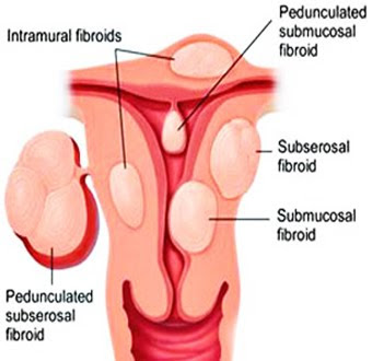 Uterine Artery Embolization treatment