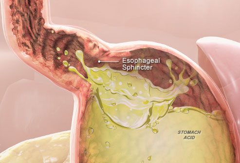  acid to seep into the oesophagus (called acidreflux), where it can