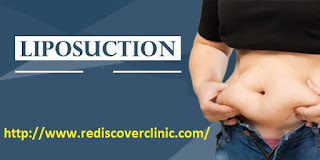 liposuction treatment