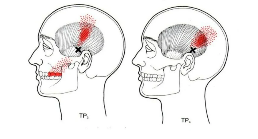 dolor cervical y dolor de cabeza - temporal tp3 y tp4 - mc spa