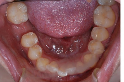 Mất răng cấm nên làm thế nào ?