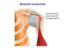 Bicipital Tendinitis