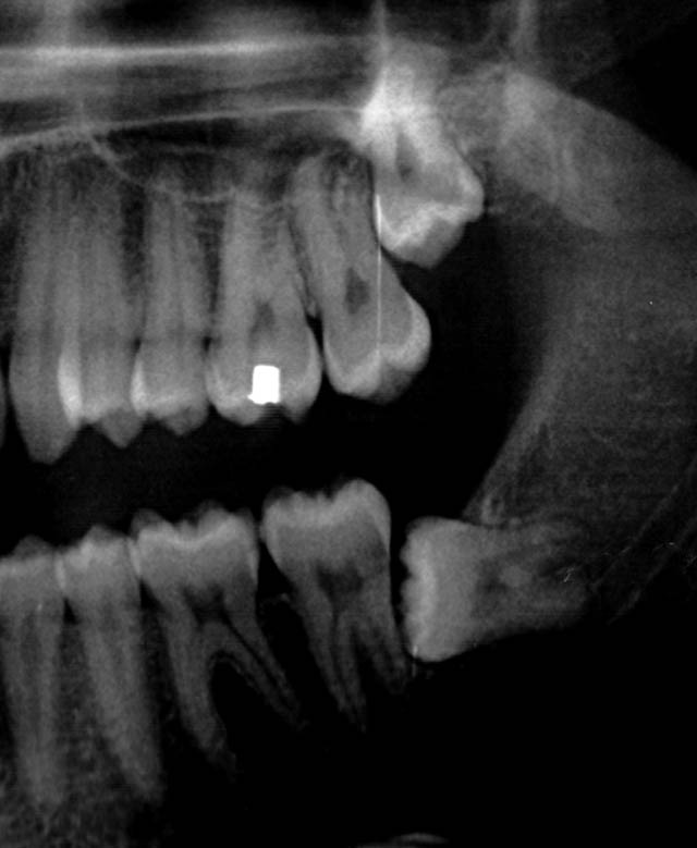 L irruption des dents de sagesse : douleurs prvoir