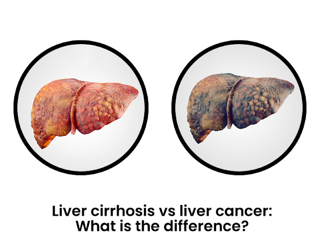 Liver Cancer and Liver Cirrhosis