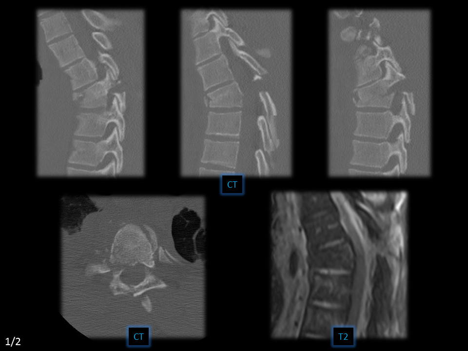 Chance fracture