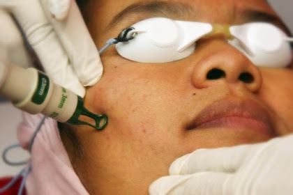 Laser Erbium dan ITED Teknologi Terbaru Untuk Acne Scars