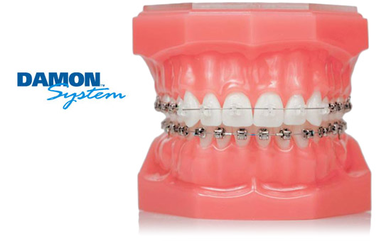 Your Markham Orthodontist Toronto Invisalign and 