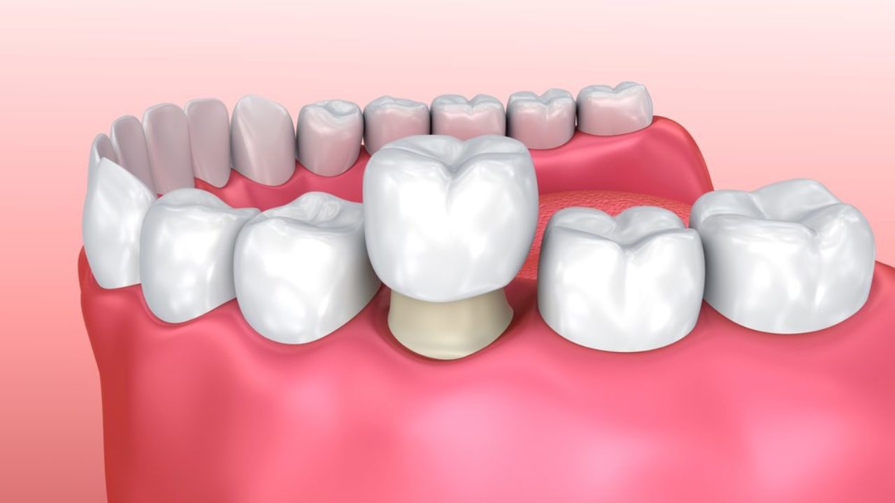 Dental Crowns