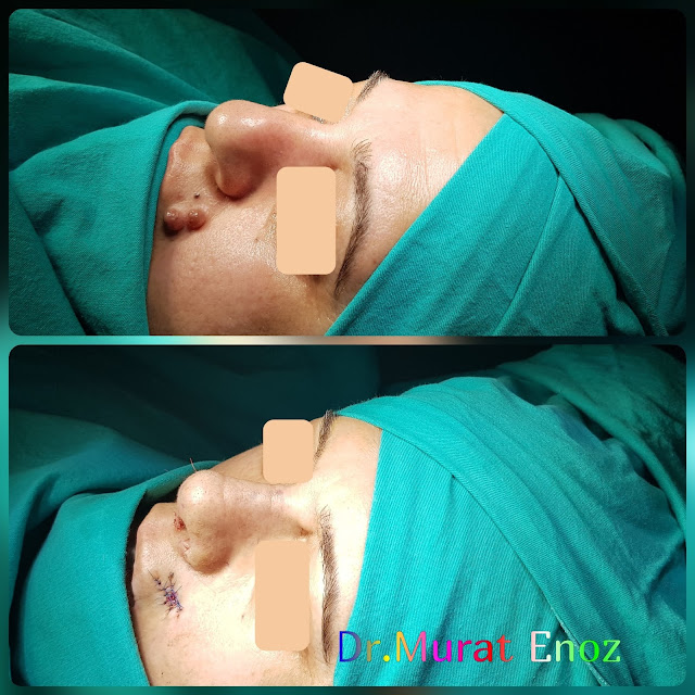 Crooked Nose Aesthetic, Nevus Excision From Lip,caudal septal dislocation, Nose Deformity,Complicated Nose Surgery