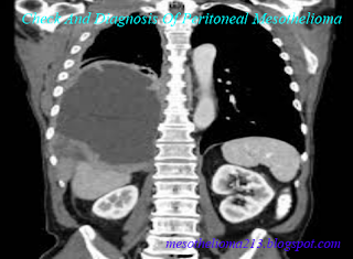 Peritoneal Mesothelioma