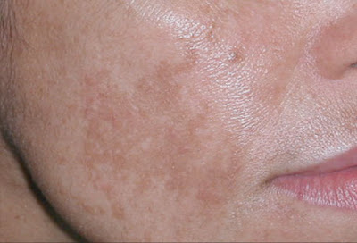 Natural treatment for melasma or cloth