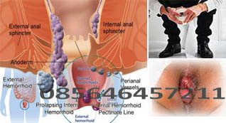 Salep Khusus Benjolan Wasir Eksternal Bengkak