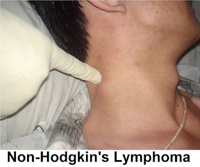 Non-Hodgkin's Lymphoma: Symptoms, Diagnosis And Treatment