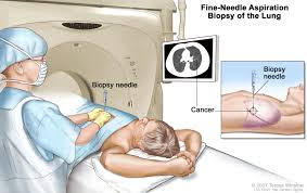 Conventional Treatment of Mesothelioma Cancer