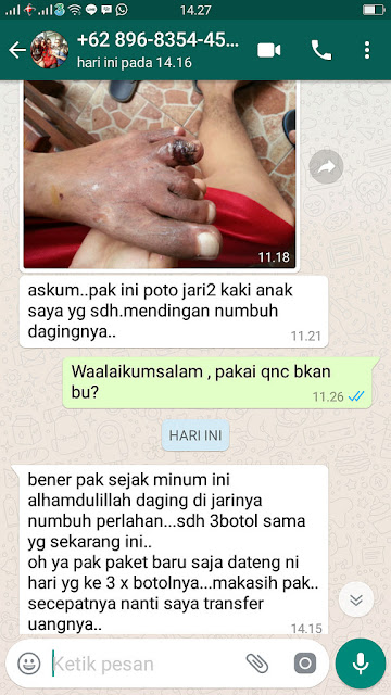 Cara Menyembuhkan Luka Gangren Diabetes Melitus