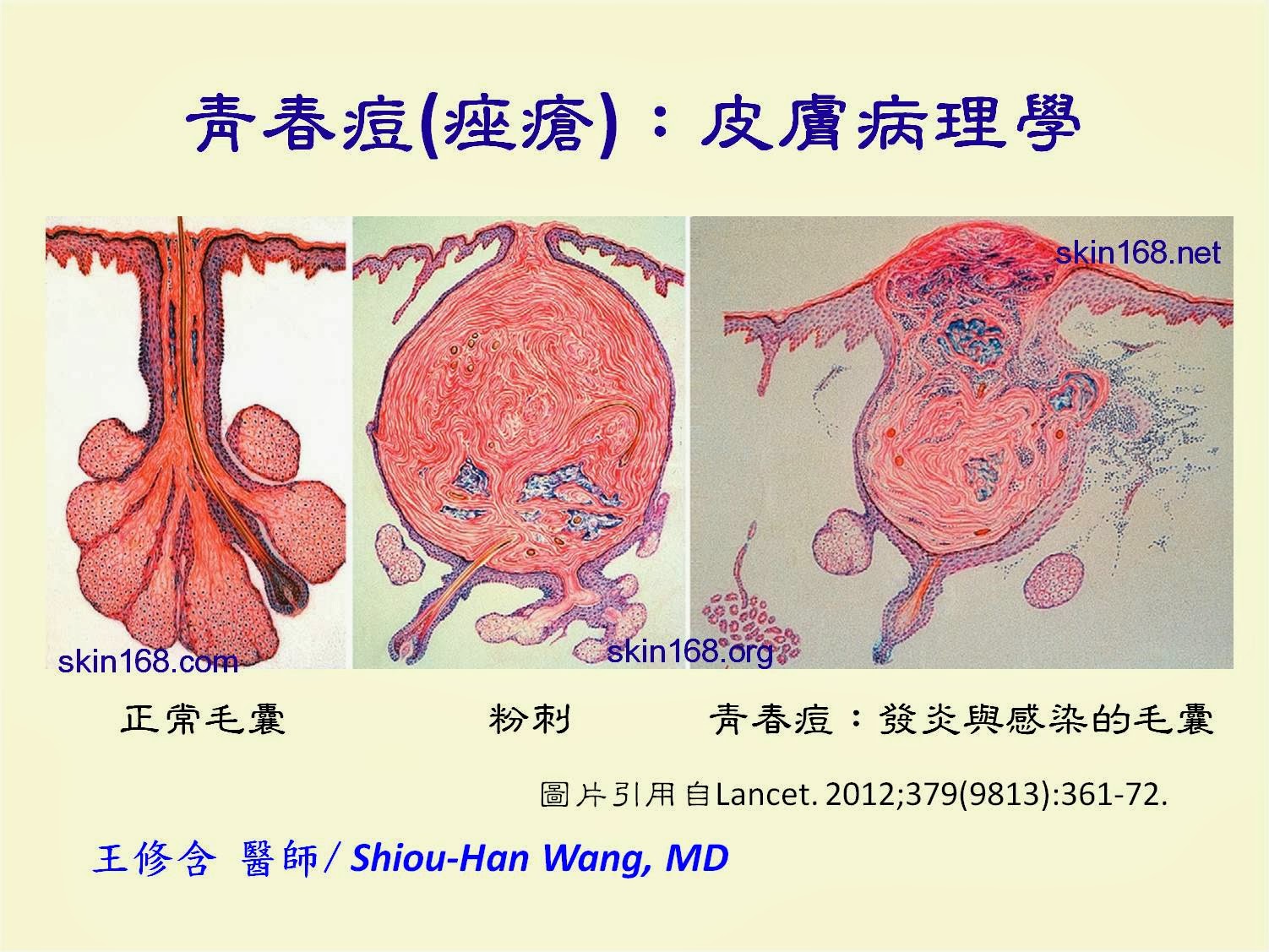 青春痘 痤瘡 面皰 粉刺 成因 治療 根治方法 皮膚科王修含醫師 青春痘 痤瘡 面皰 粉刺 成因 治療 根治方法 皮膚科王修含醫師