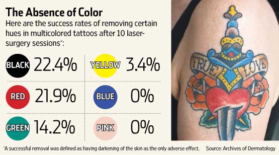 Tattoo Laser Removal