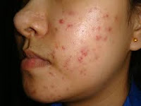 symptoms of acne