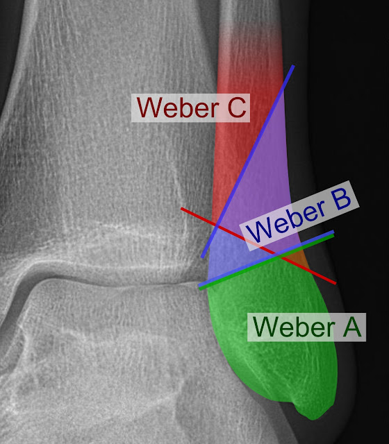 Weber fracture Classification - Weber A fracture,Weber B fracture,Weber C fracture - Treatment, surgery recovery time