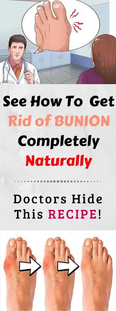 Doctors Hide This Recipe! Here’s How To Get Rid of Bunions Completely Naturally!
