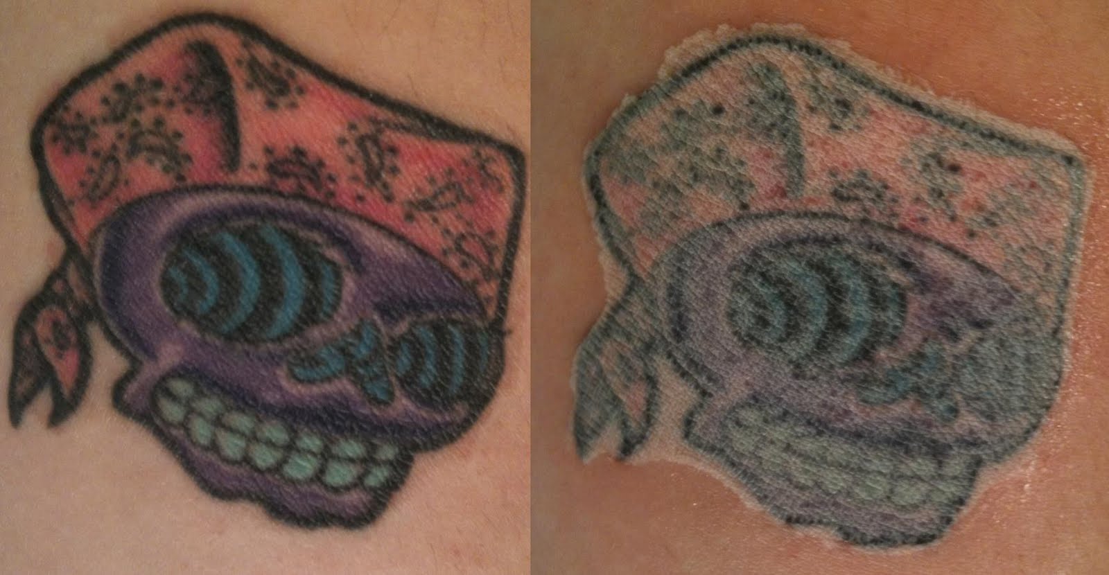 TCA Tattoo Removal Before and After